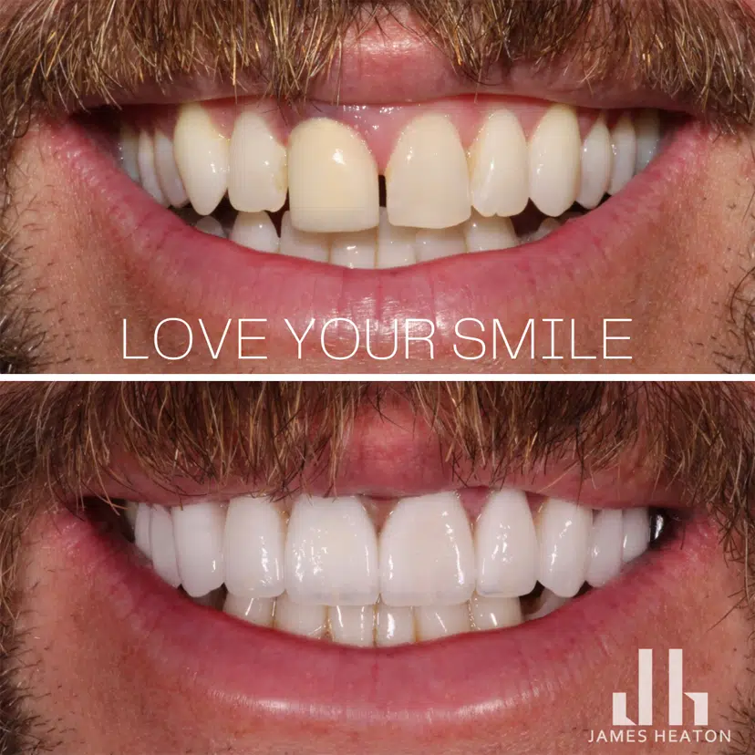Male Teeth Veneers Before and After Photos | Smiles of Chandler in Chandler, AZ