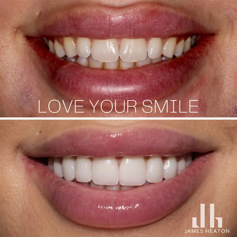 Female Teeth Veneers Before and After Photos | Smiles of Chandler in Chandler, AZ