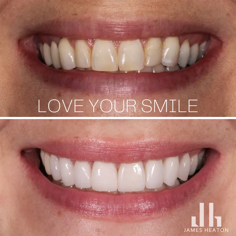 Female Teeth Veneers Before and After Photos | Smiles of Chandler in Chandler, AZ