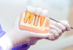 Smilesof Chandler Blog Dental Implants Tempe in Chandler AZ