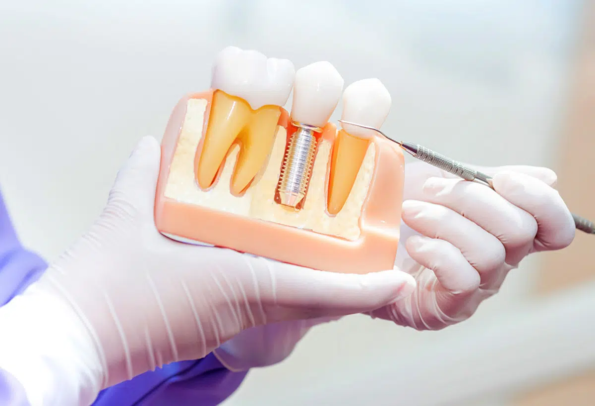 Dentist Holding Dental Implant Model | Smiles of Chandler in Chandler, AZ