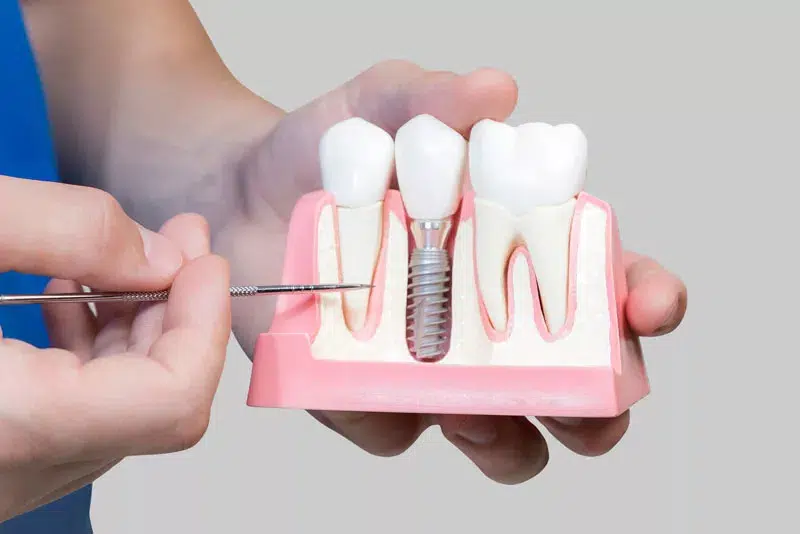 Dentist Holding Dental Implant Model | Smiles of Chandler in Chandler, AZ