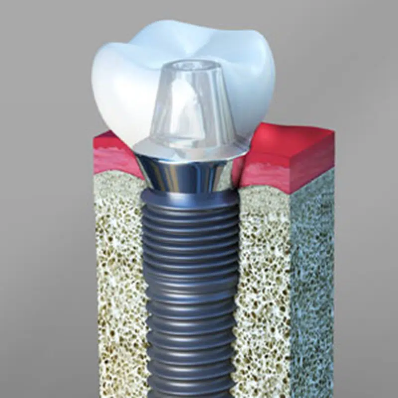 Dental Implant Blog | Smiles of Chandler in Chandler, AZ