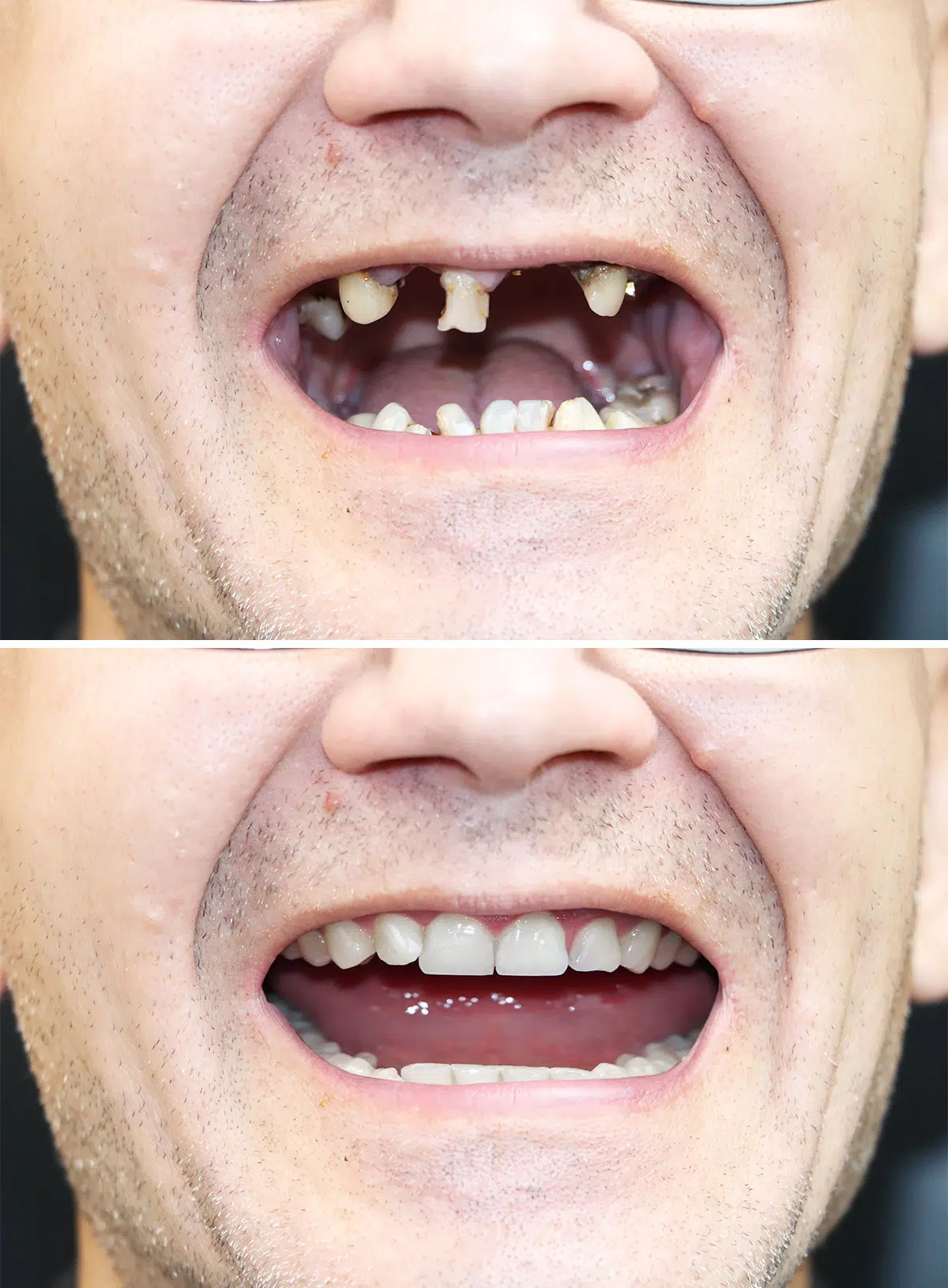 Male Dental Implant Before and After Photos | Smiles of Chandler in Chandler, AZ