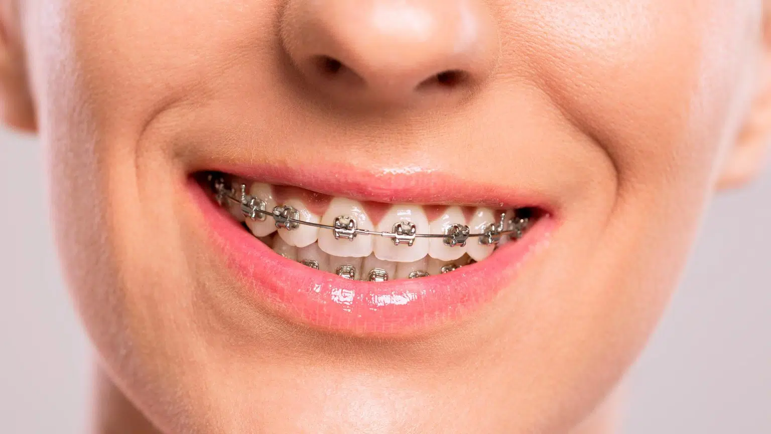 Getting Braces Top Things You Need To Know in Chandler AZ | Smiles Of Chandler in Chandler, AZ