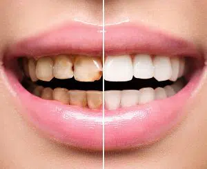 smilesofchandler 5 Reasons For Cosmetic Dentistry in chandler az
