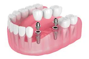 smilesofchandler 5 Reasons For Cosmetic Dentistry one in chandler az