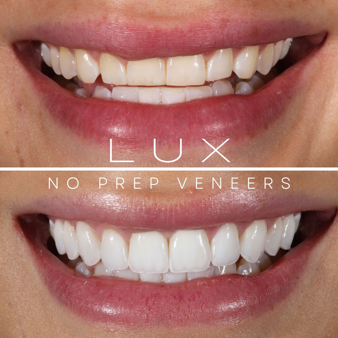 Lux No Preparation Veneers