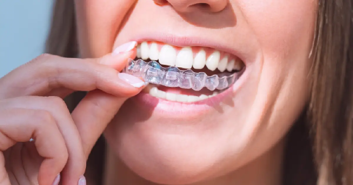 Invisalign by Smiles of Chandler in Arizona