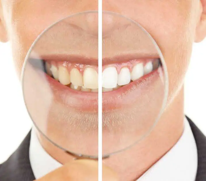 Zoom Teeth Whitening in Chandler, AZ by Smiles of Chandler