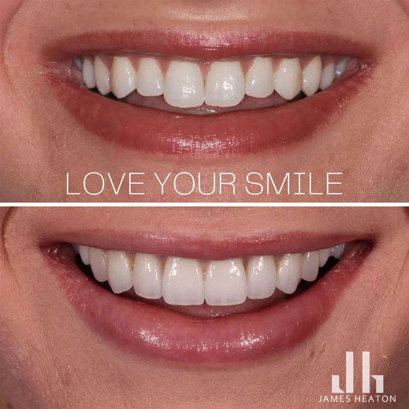 Female Teeth Veneers Before and After Photos | Smiles of Chandler in Chandler, AZ