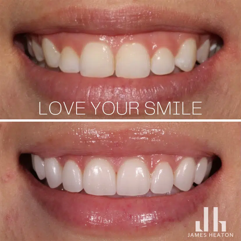 Female Teeth Veneers Before and After Photos | Smiles of Chandler in Chandler, AZ
