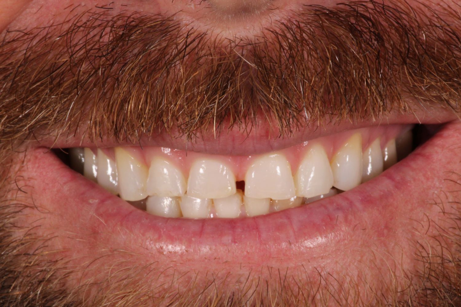 Before