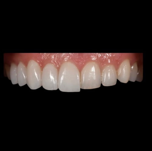 Gallery-Chandler LUX No Veneer